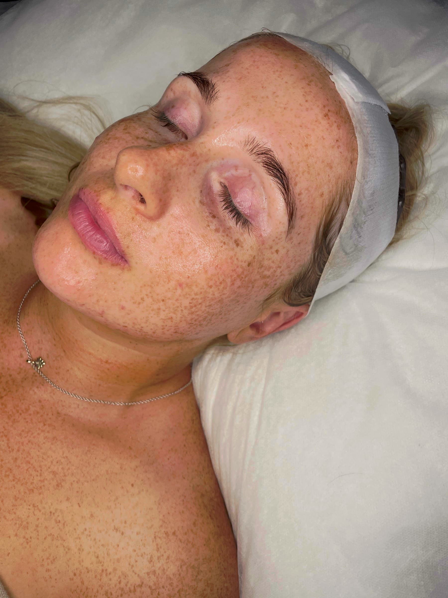 Client resting on the treatment bed at Fresh Faced straight after dermaplaning, skin smooth and freckles bright with no peach fuzz.