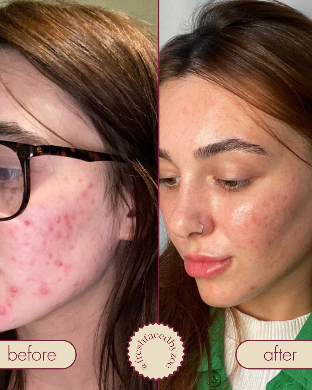 Before and after at Fresh Faced showing clearer skin and noticeably fewer breakouts.