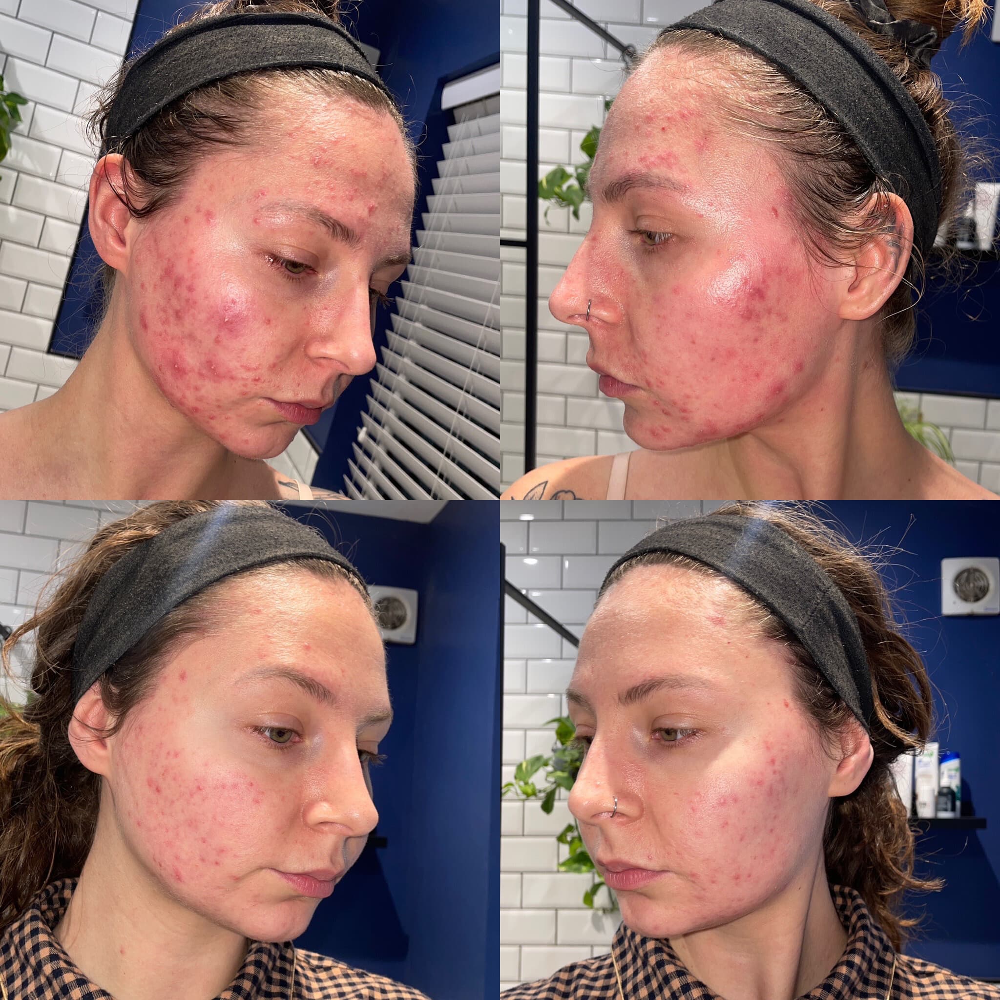 Four-panel acne programme journey at Fresh Faced showing significant clearing over the course of the plan.