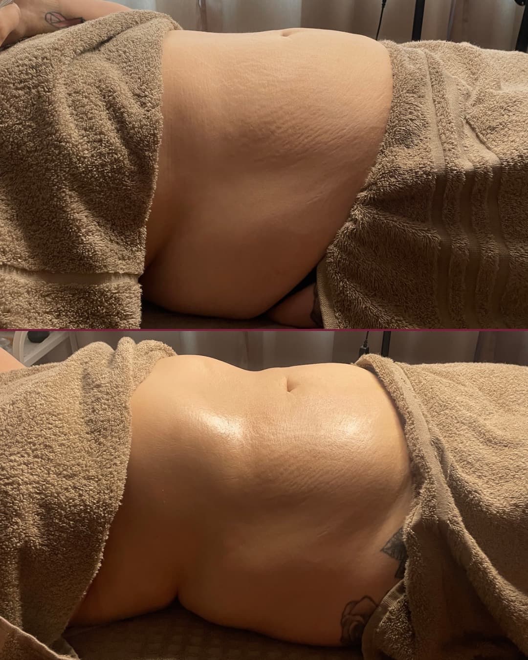 Before and after lymphatic drainage massage at Fresh Faced, showing a flatter, less bloated stomach in a single session.