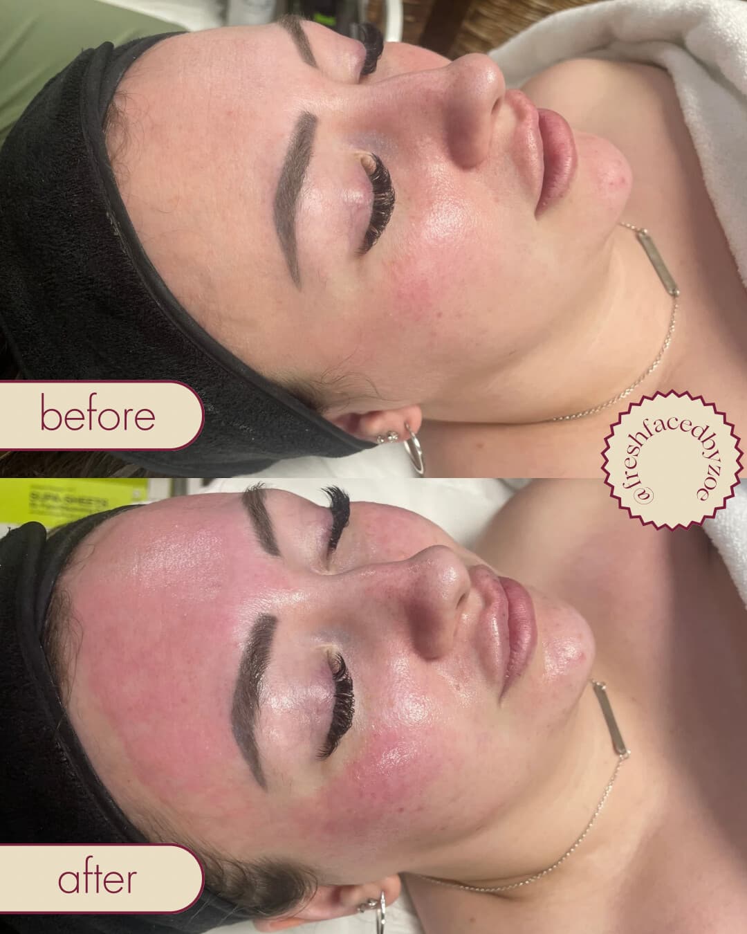Before and after at Fresh Faced showing skin texture refined and post-treatment glow.