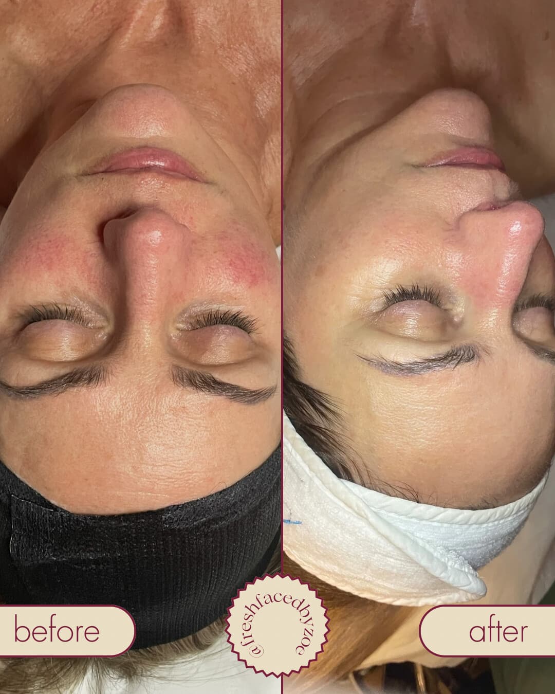 Before and after at Fresh Faced showing reduced redness and a calmer, more even complexion.