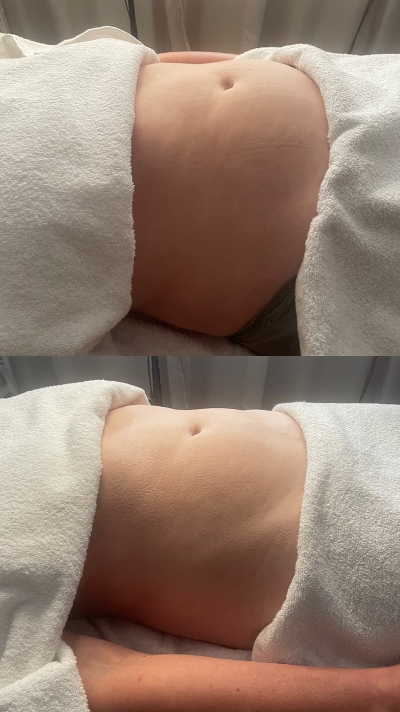 Before and after a body lymphatic drainage session at Fresh Faced, showing a flatter, less bloated midsection.